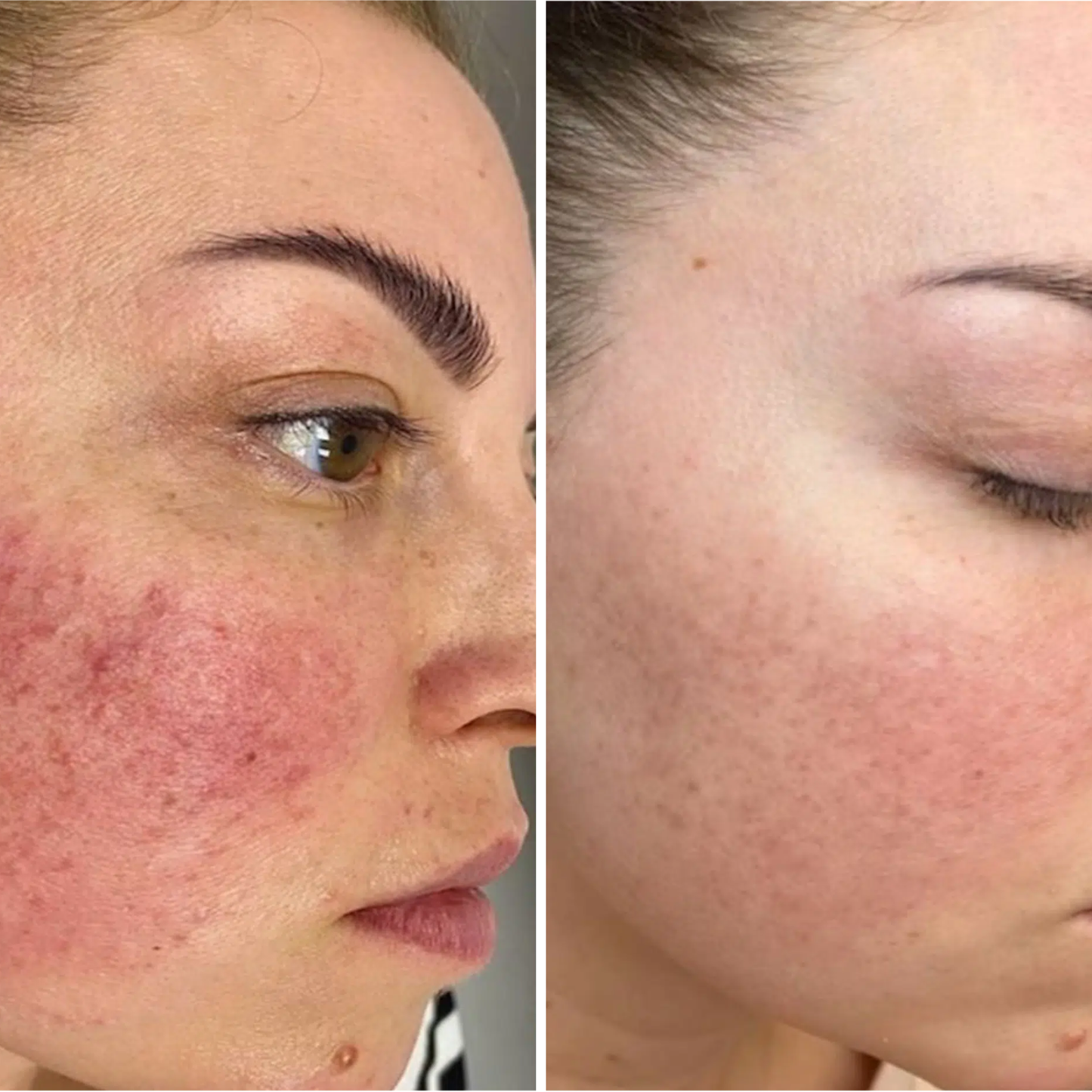 Kolaé Anti-Redness Serum