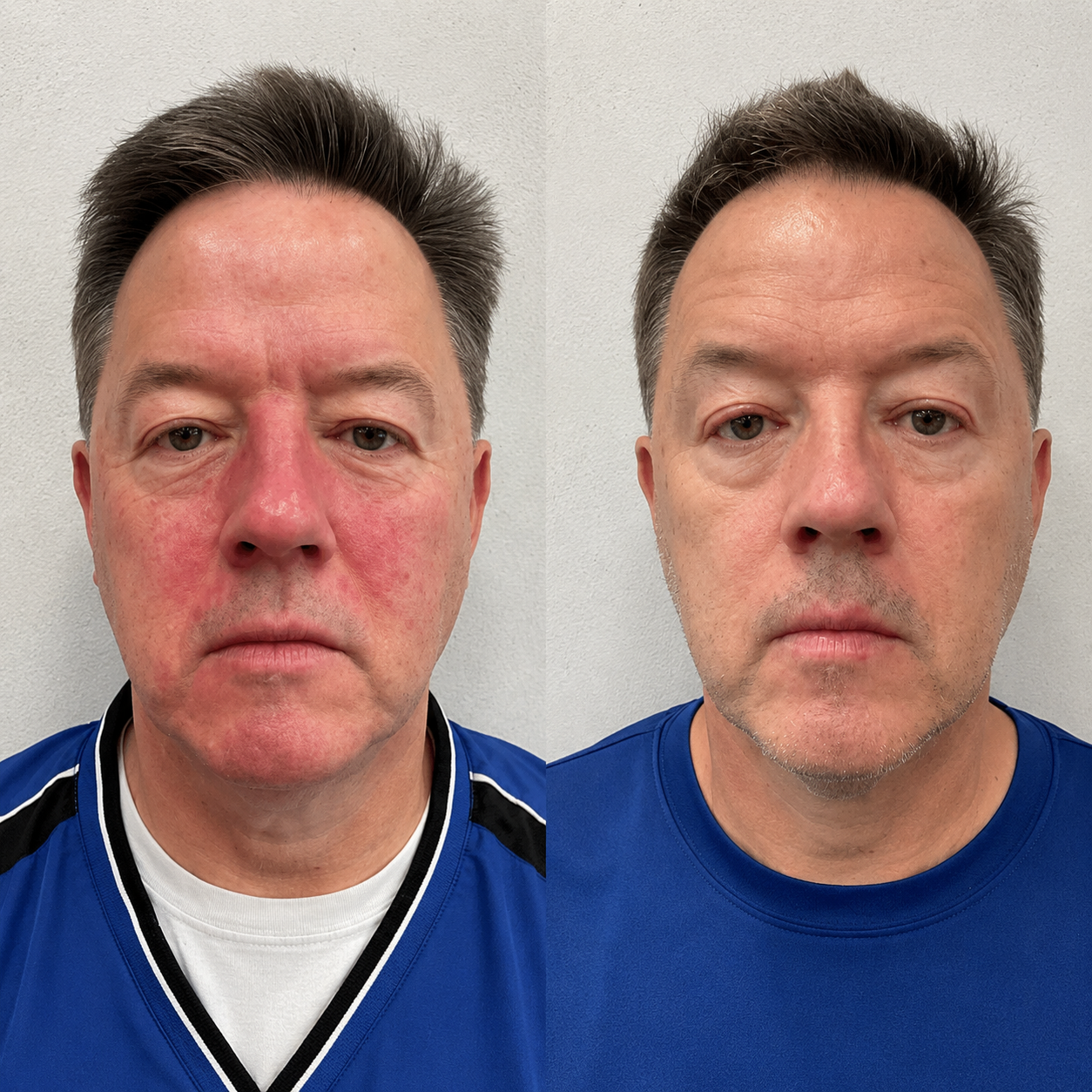 Kolaé Anti-Redness Serum Man