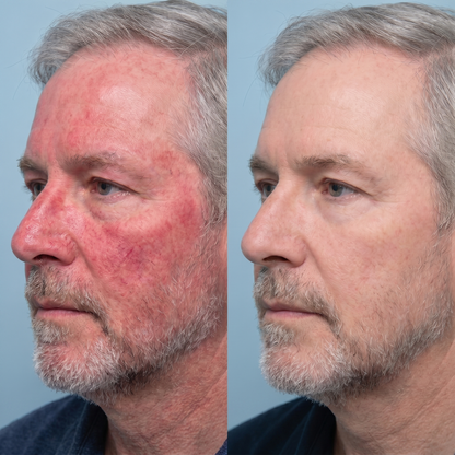 Kolaé Anti-Redness Serum Man